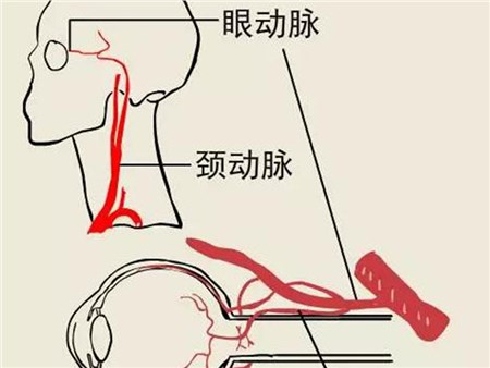 视网膜动脉阻塞