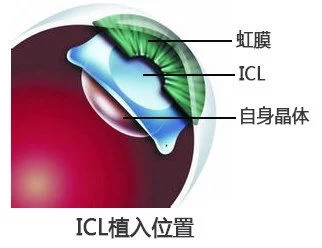 适合高度近视患者的近视手术