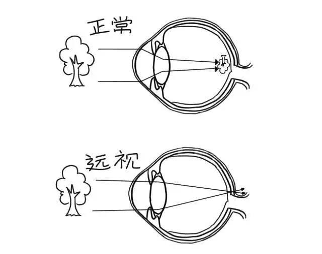 儿童远视比近视危害更大？